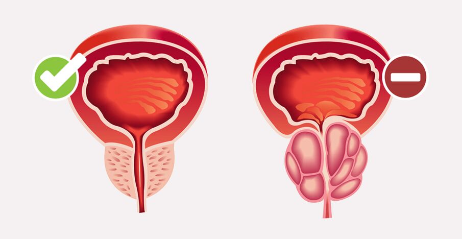 Weiprost normalizes prostate size and function