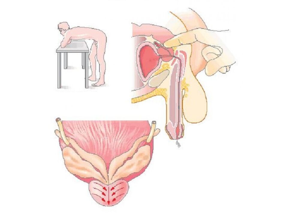 Prostate massage technique by a doctor to take a secretion analysis